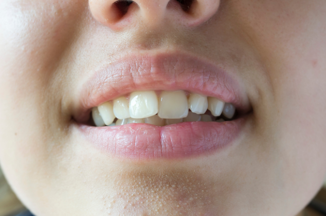 Misaligned Teeth and Bite Problems: An Overview