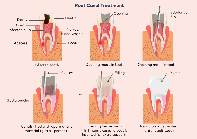 root canal treatment Singapore