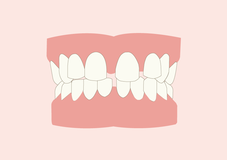 2_spacing-gap-between-teeth_-benefits-of-Invisalign-Pic1 - DP Dental