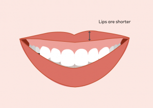 Point_5-Shorter-Upper-lips