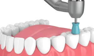 How does Teeth Polishing Work?