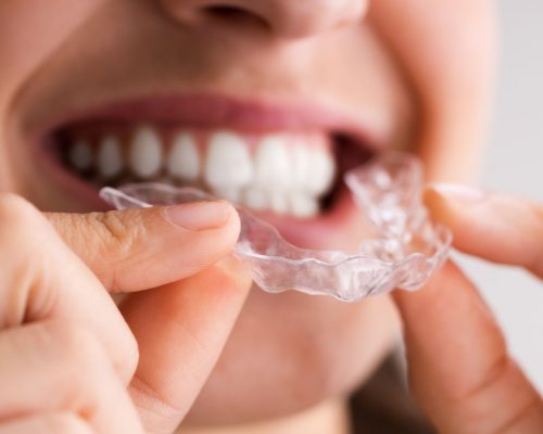 invisalign first clear aligners for kids