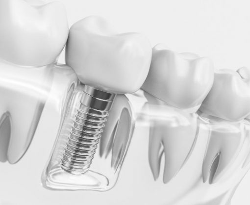 Restoring natural teeth functions